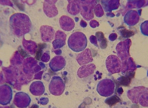 Abnormal lymphocytes