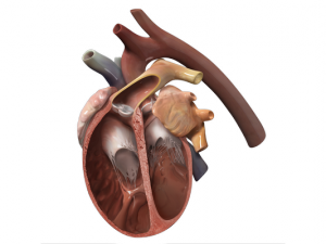 Dilated Cardiomyopathy