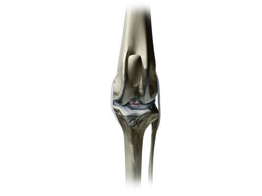 Illustration showing a tear in the cranial cruciate ligament of the knee joint