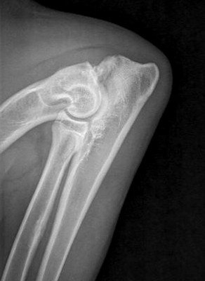 X-ray demonstrating elbow dysplasia