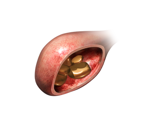 Stones can form in the urinary bladder resulting in irritation and potentially obstruction