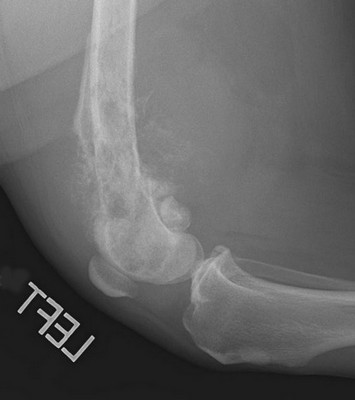 Bone weakened by osteosarcoma has caused a fracture